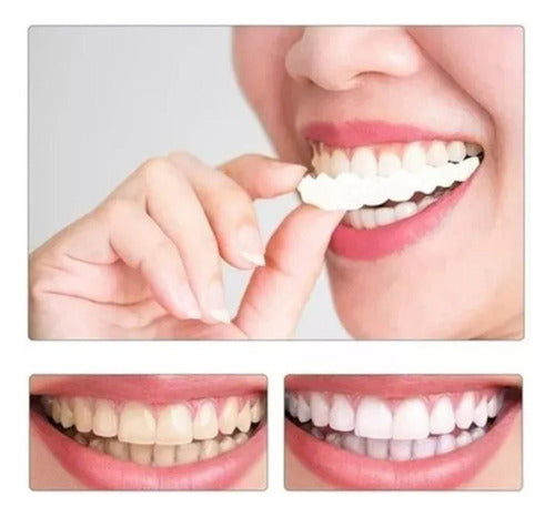 Carillas Estéticas Snap On Smile Veneers Dientes Temporales