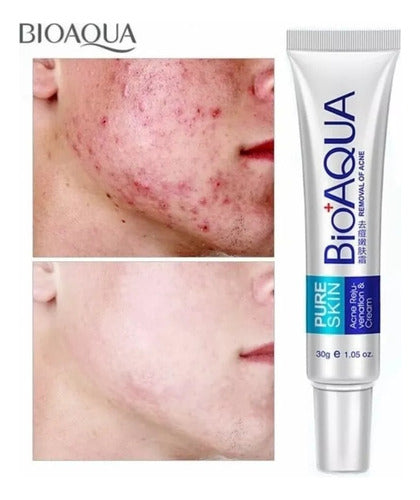 Bioaqua Pure Skin Crema Anti Acne Remueve Manchas Cicatrices