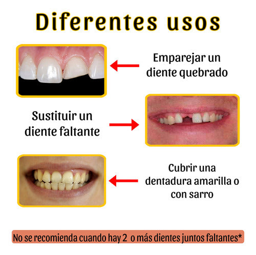 Carillas Snap On Smile Veneers Dientes Temporales Estéticas